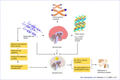Graphical Abstract of Ependymoma
