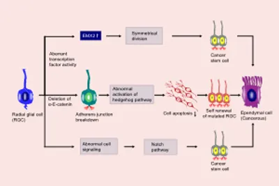 Tumorigenesis of Ependymoma