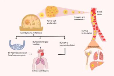 Metastasis in Ependymoma