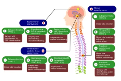 Therapeutics of Ependymoma