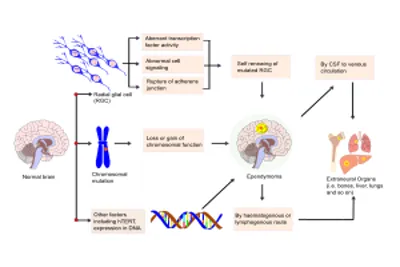 Pathophysiology of Ependymoma